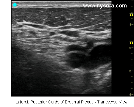Ultrasound image of the lateral and posterior cords of the brachial plexus transverse view