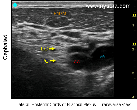 Ultrasound image of the labeled lateral and posterior cords of the brachial plexus transverse view