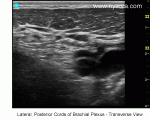 Infraclavicular Brachial Plexus